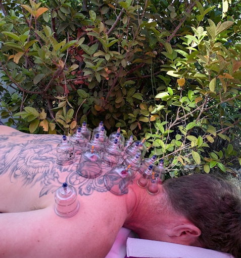 Picture of Cupping Technique on Back